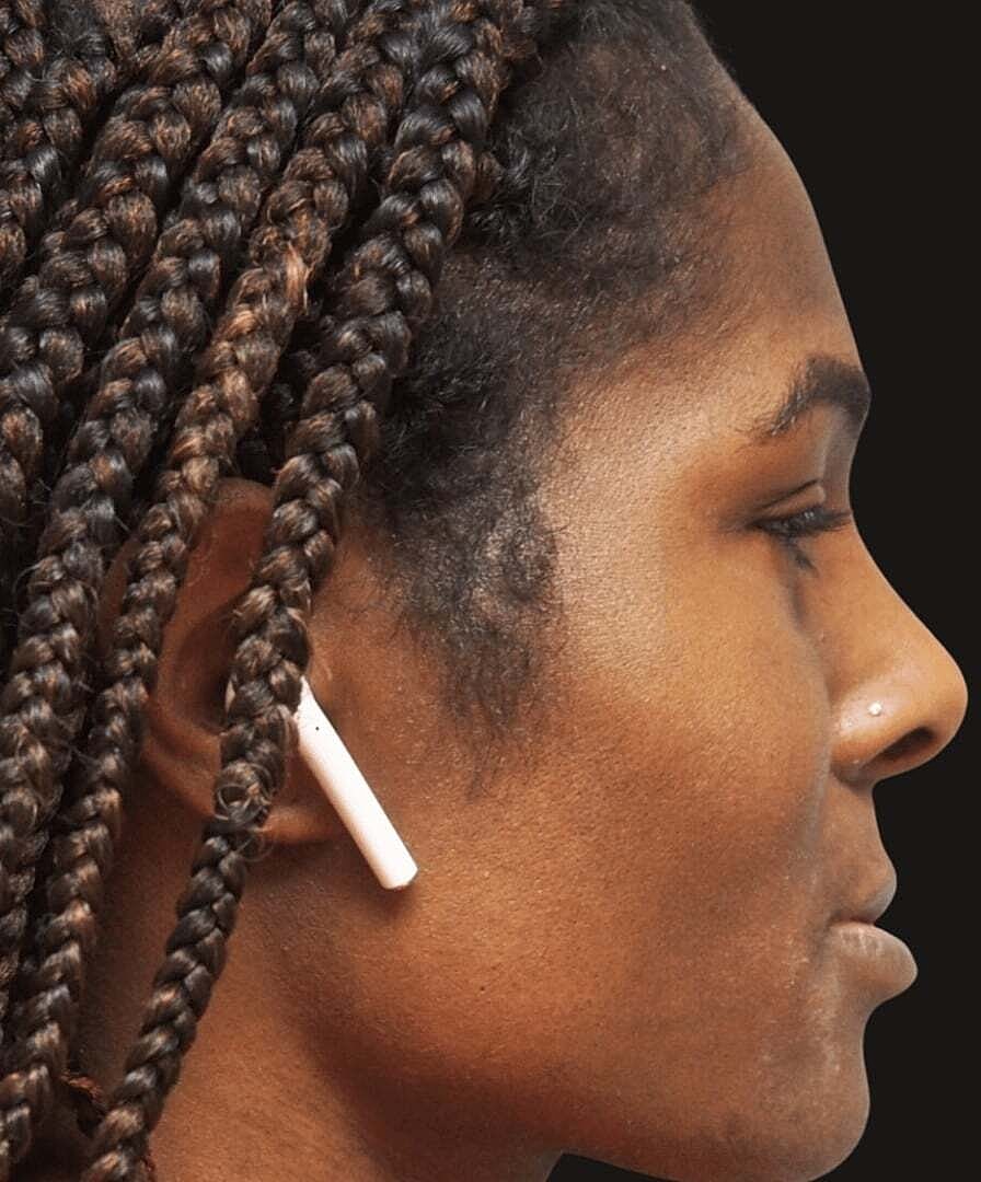 Rhinoplasty Before & After