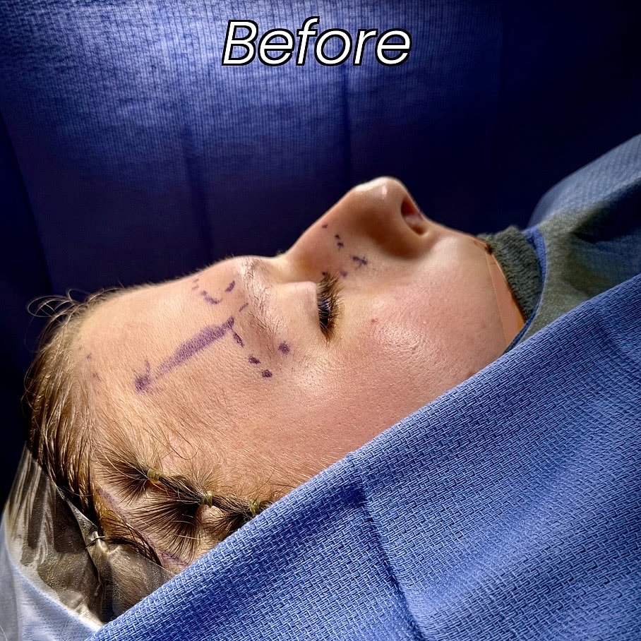 Rhinoplasty Before & After