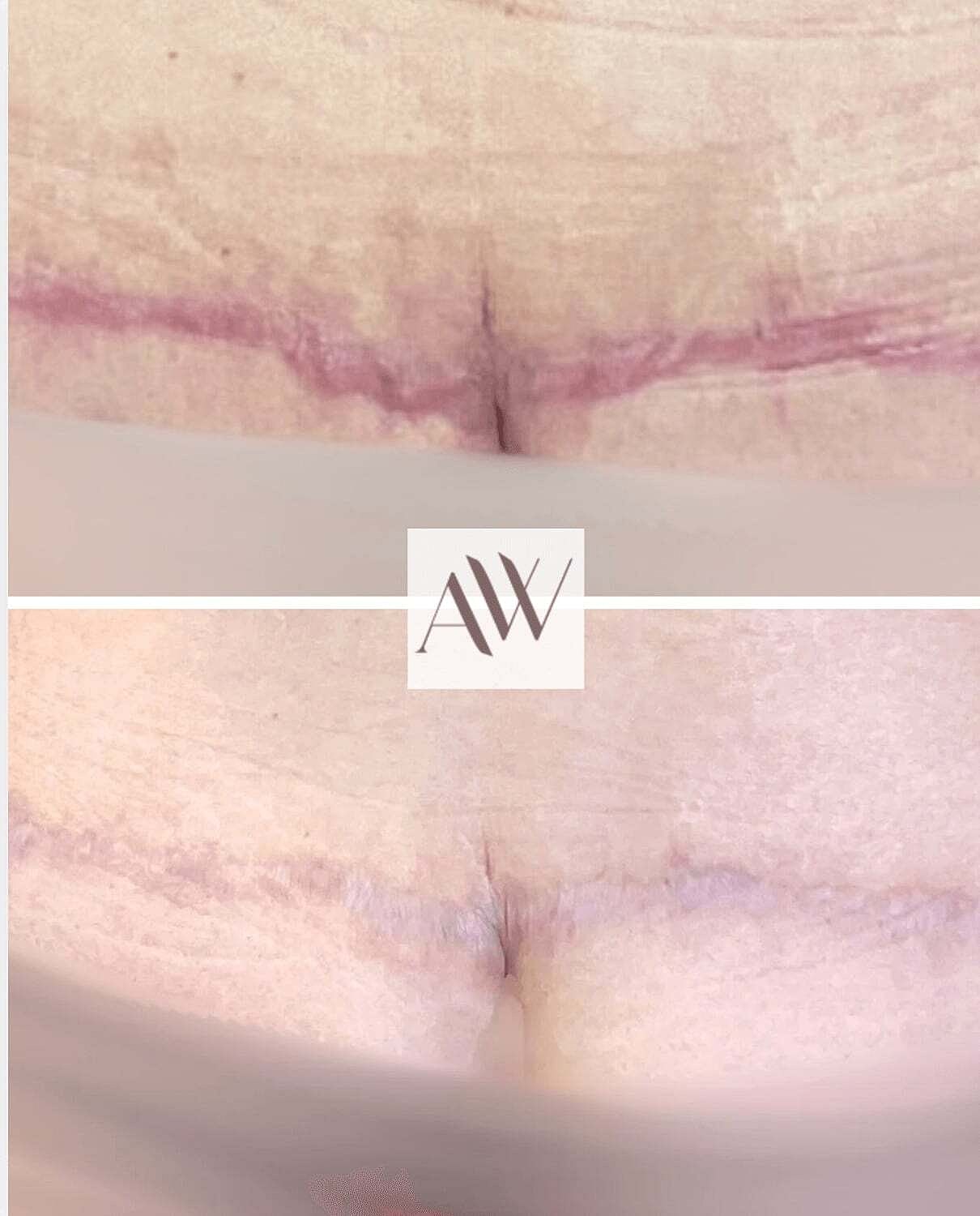 Rf Microneedling Before & After