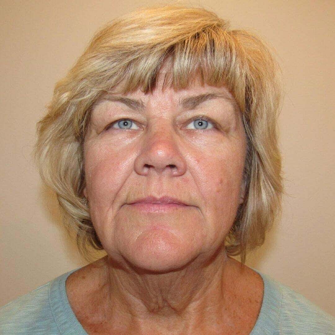 Facelift And Neck Lift Before & After