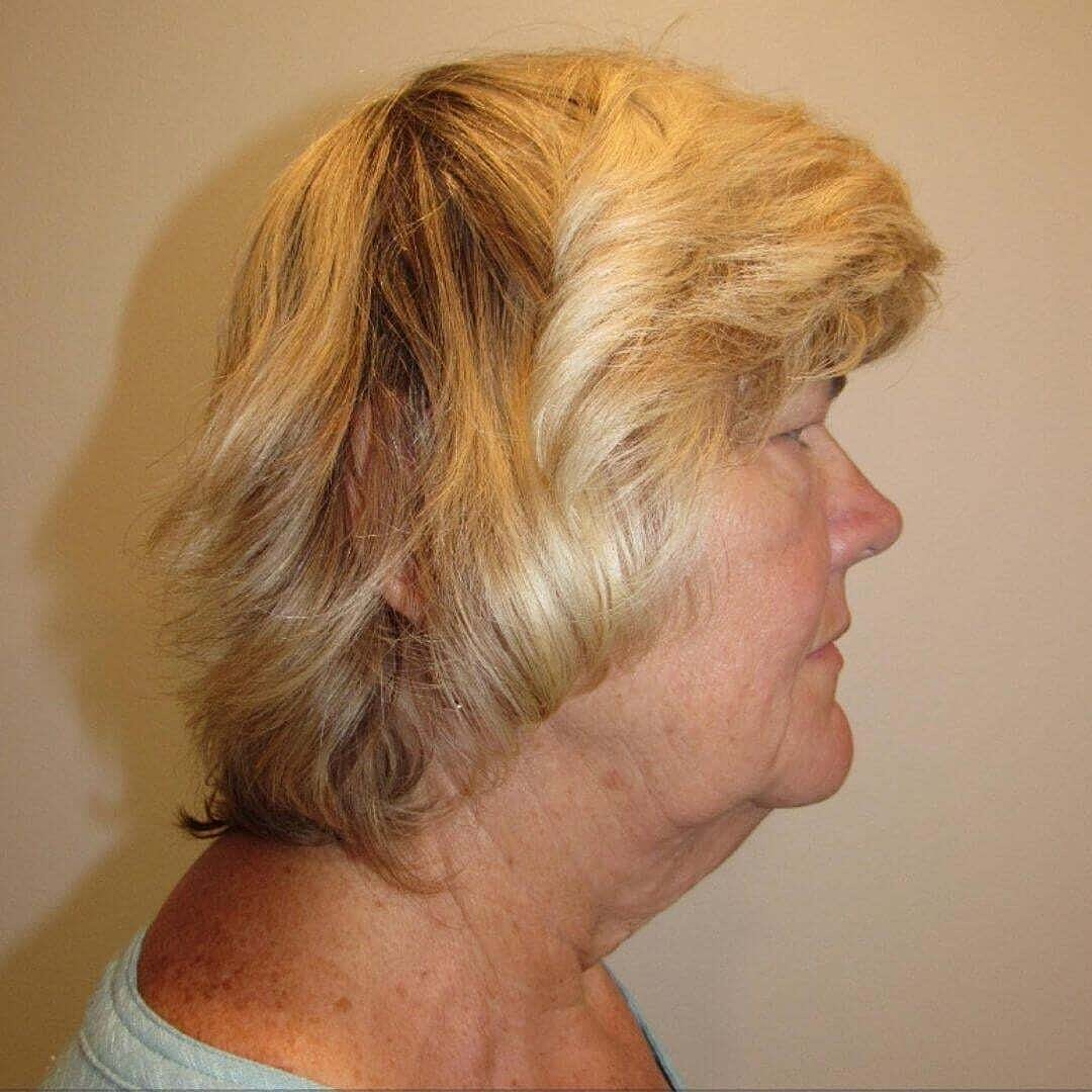 Facelift And Neck Lift Before & After