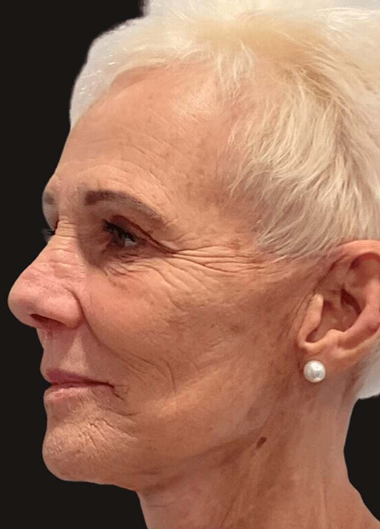 Facelift And Neck Lift Before & After