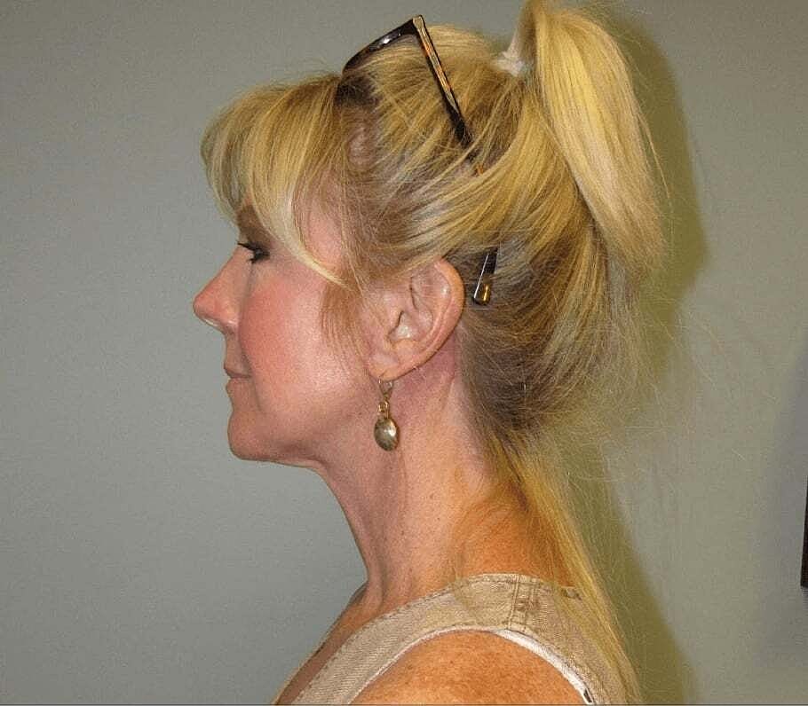 Facelift And Neck Lift Before & After