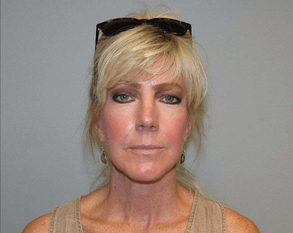 Facelift And Neck Lift Before & After