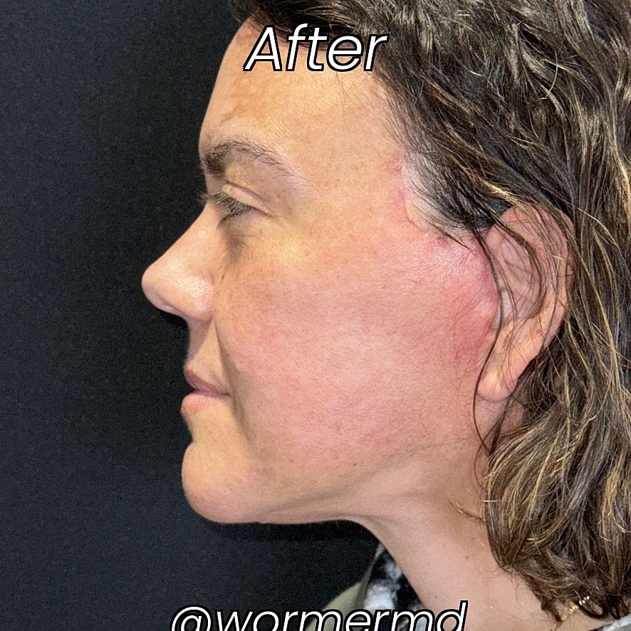 Facelift And Neck Lift Before & After