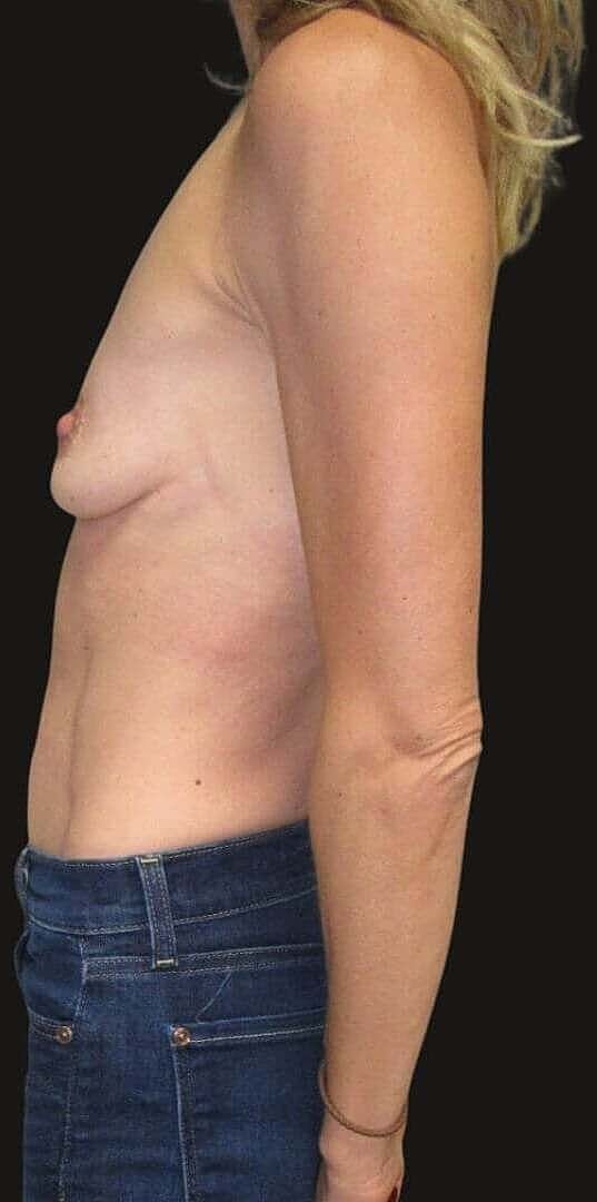 Breast Augmentation Before & After
