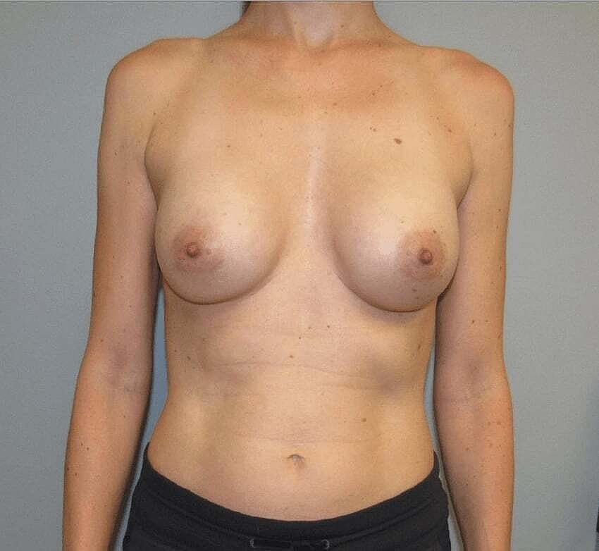 Breast Augmentation Before & After