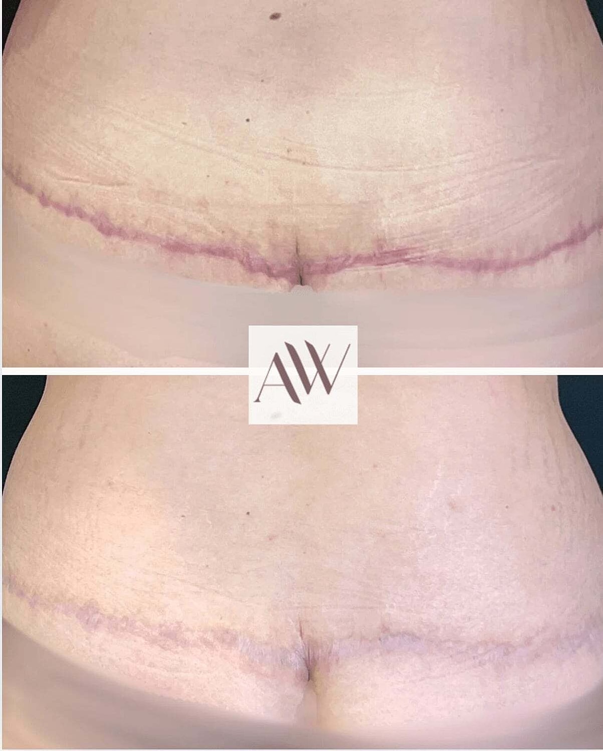 Ipl Before & After
