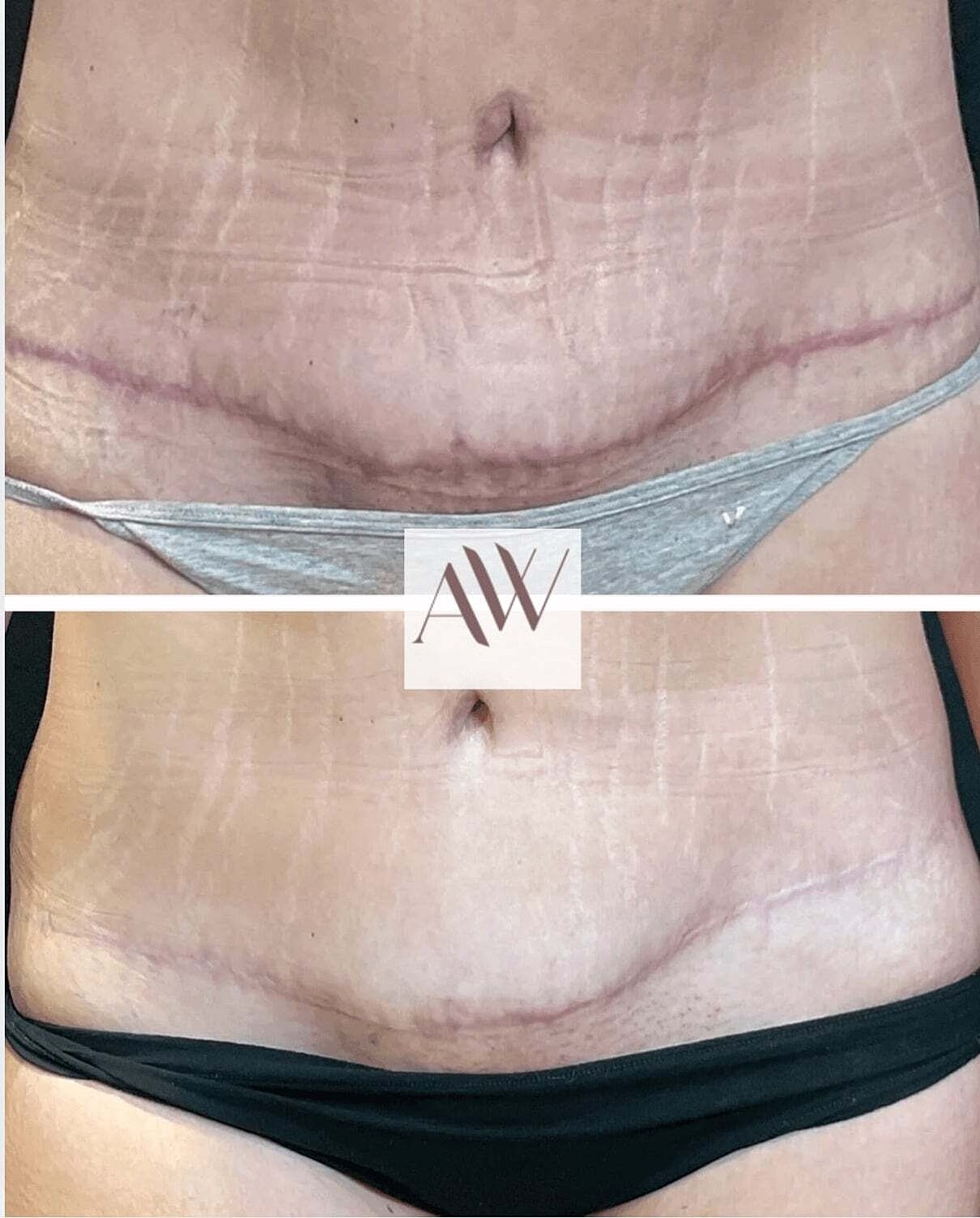 Abdominoplasty Before & After