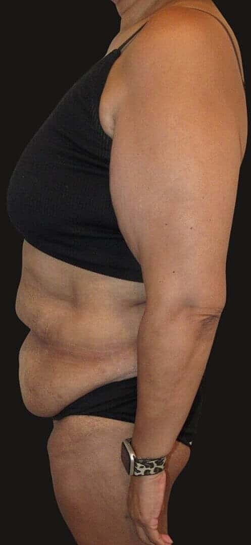 Abdominoplasty Before & After