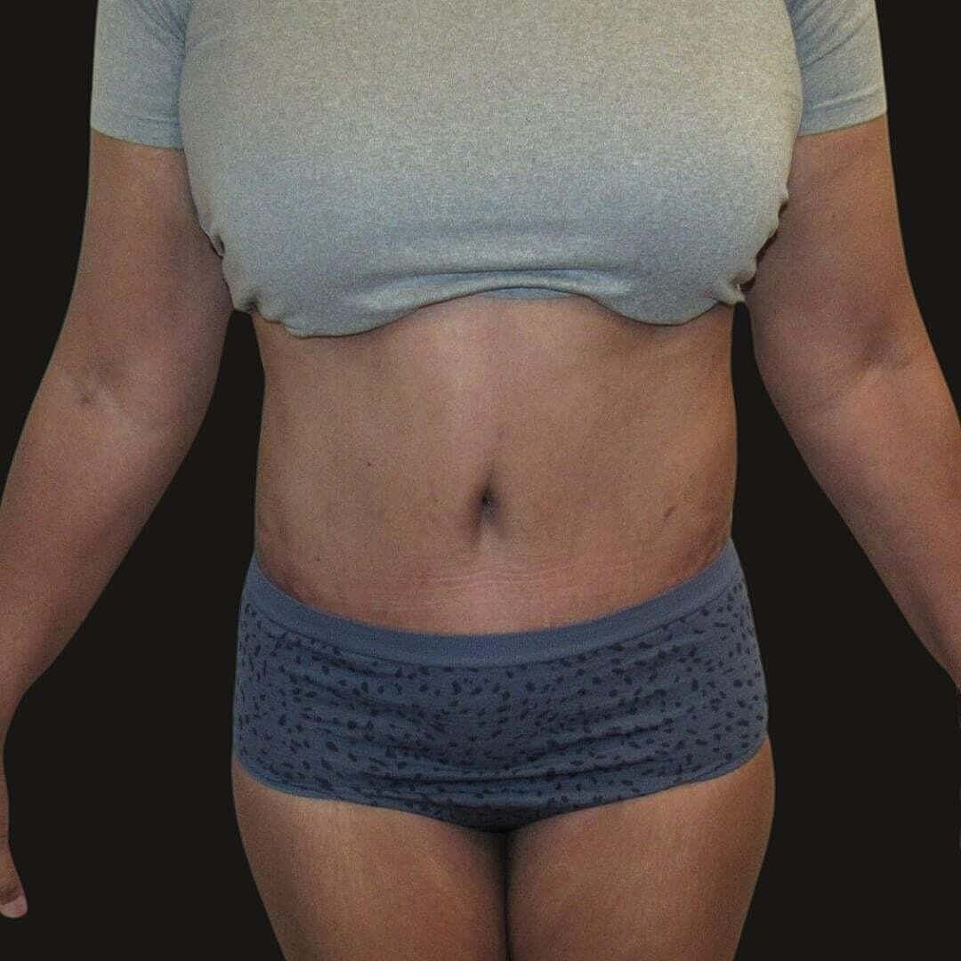 Abdominoplasty Before & After