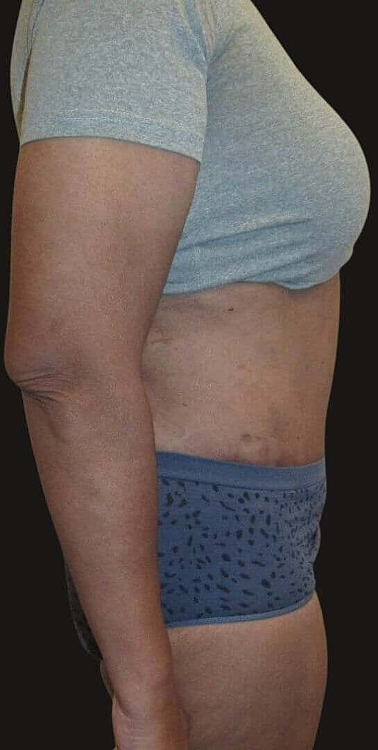 Abdominoplasty Before & After