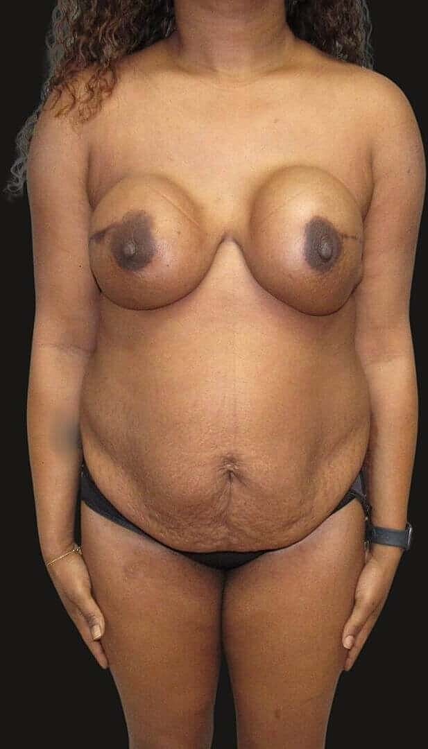 Abdominoplasty Before & After