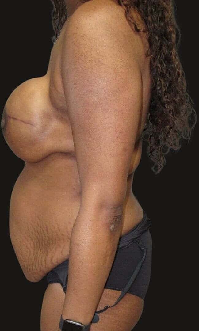 Abdominoplasty Before & After