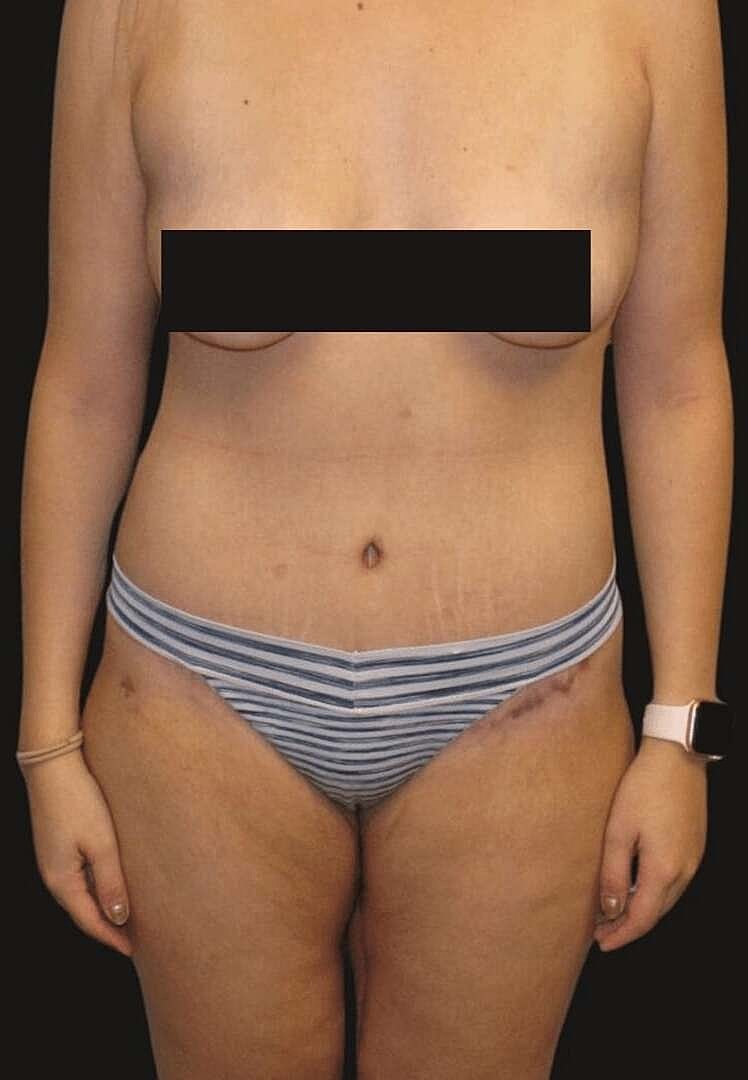 Abdominoplasty Before & After