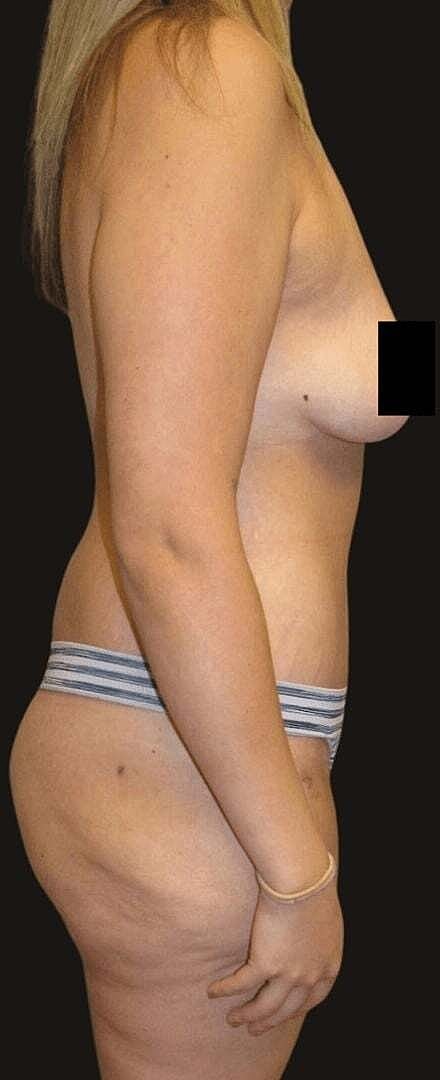 Abdominoplasty Before & After