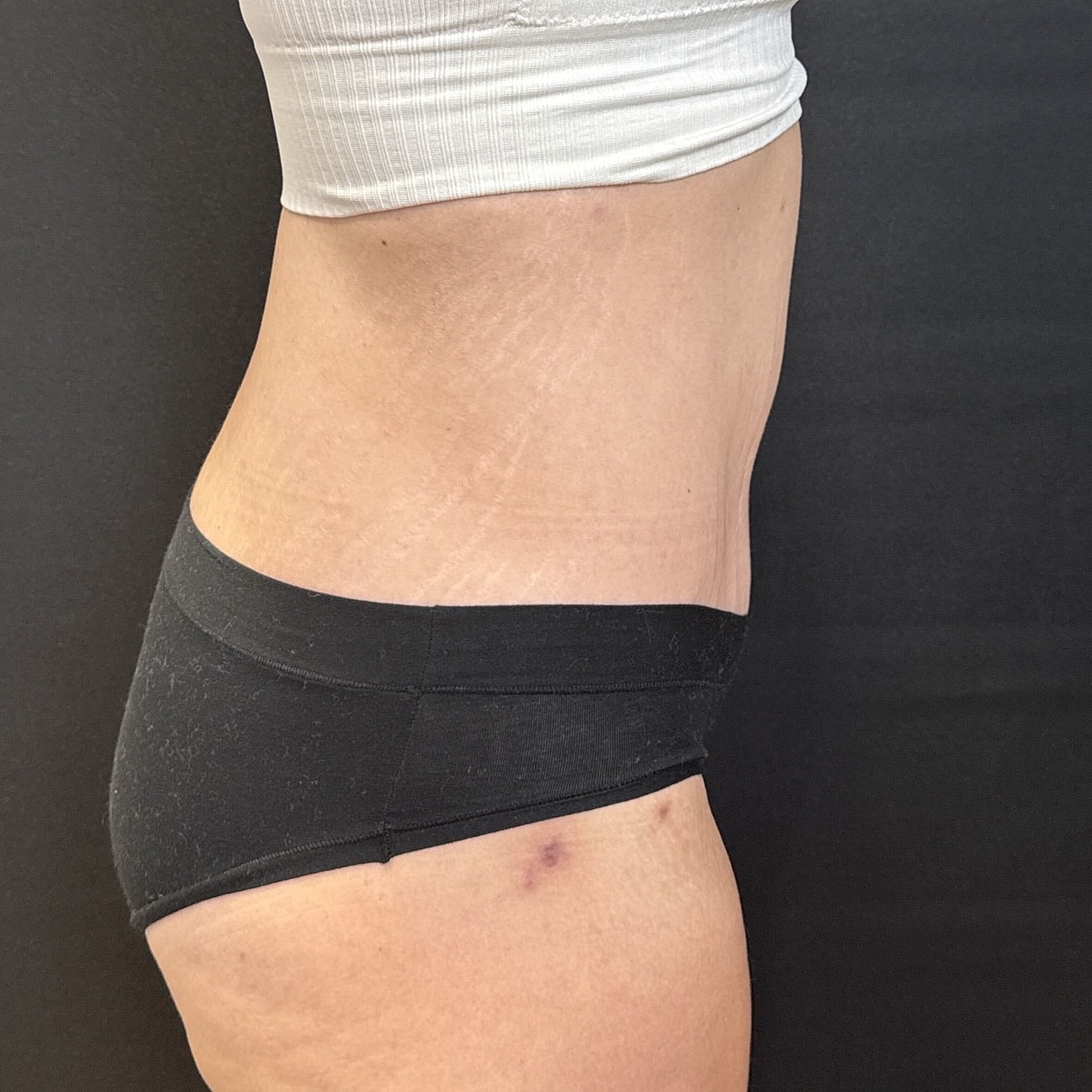 Abdominoplasty Before & After