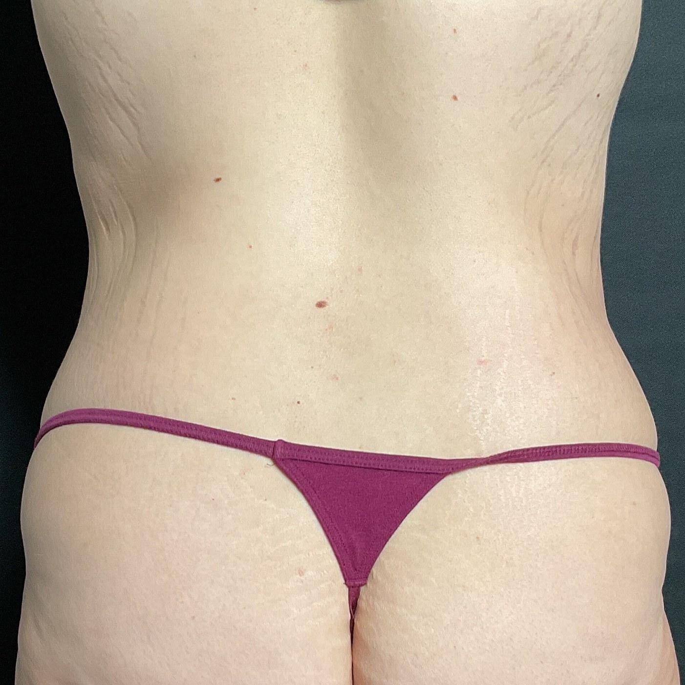 Abdominoplasty Before & After