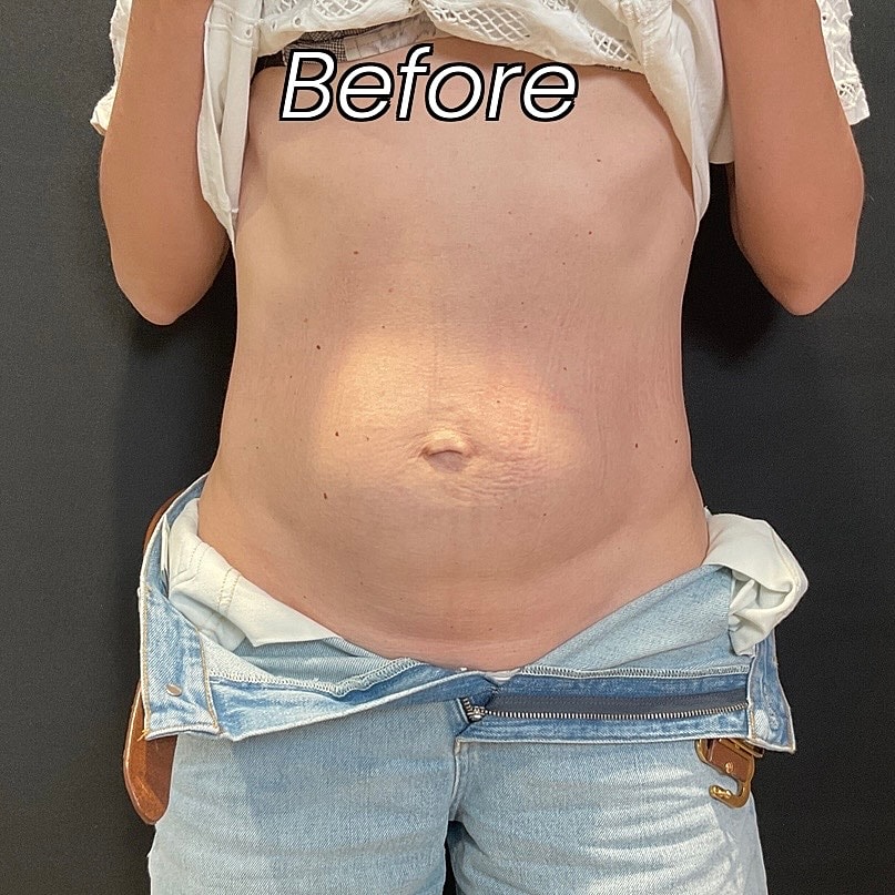 Abdominoplasty Before & After
