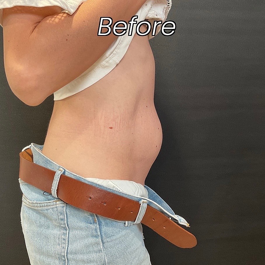 Abdominoplasty Before & After