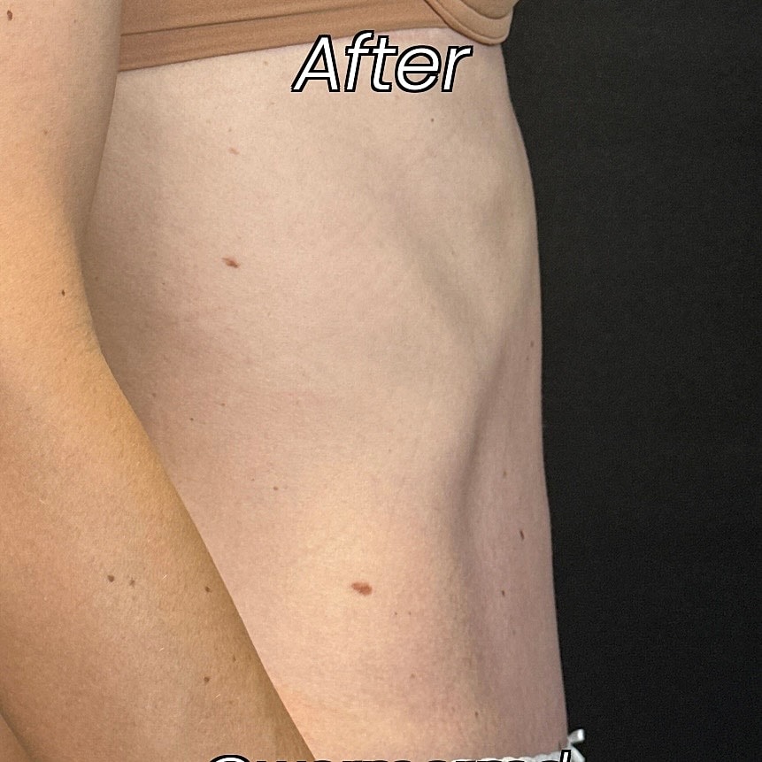 Abdominoplasty Before & After