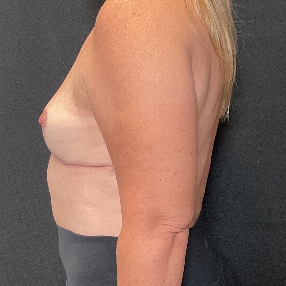 Breast Implant Removal Before & After