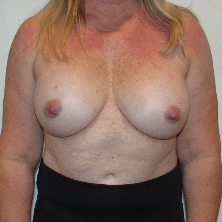 Breast Implant Removal Before & After
