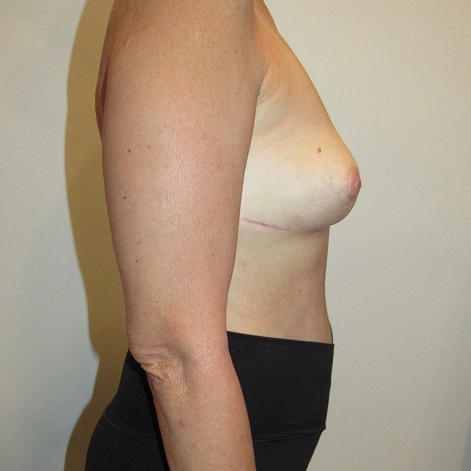 Breast Implant Removal Before & After