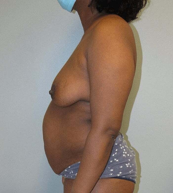 Mommy Makeover Before & After