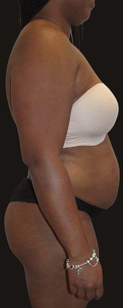 Liposuction Before & After