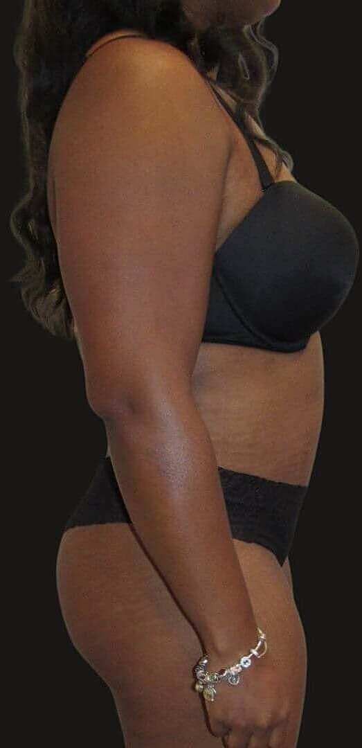 Liposuction Before & After
