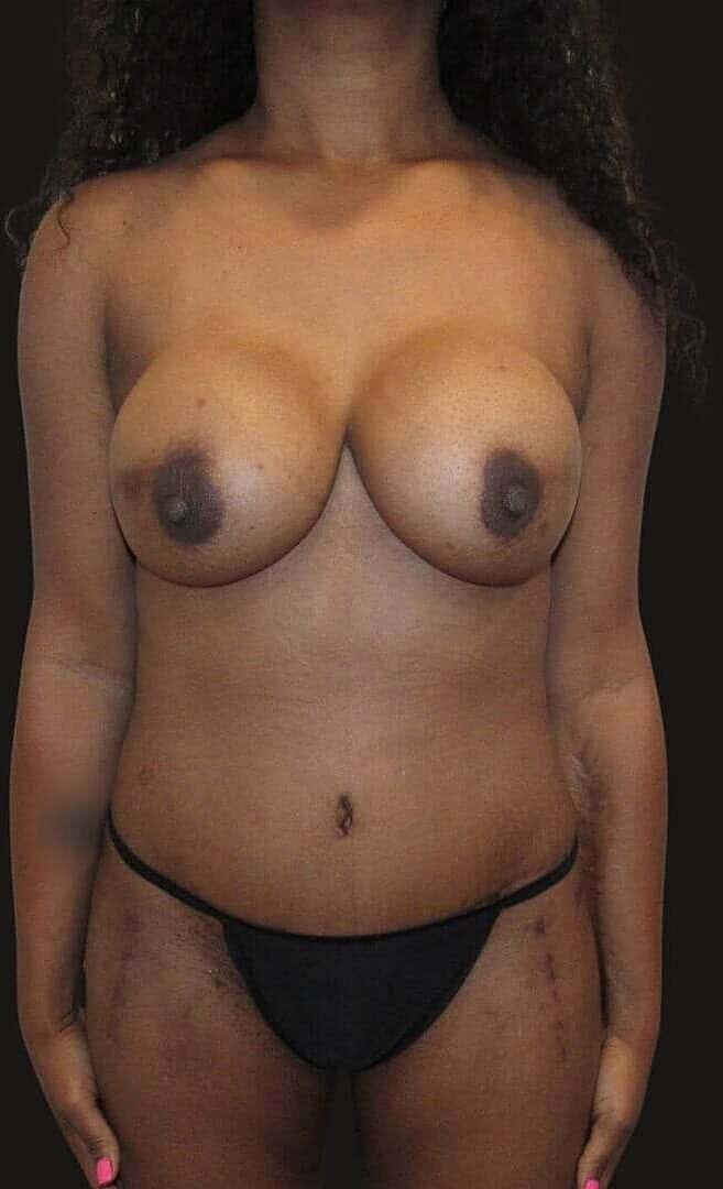 Liposuction Before & After