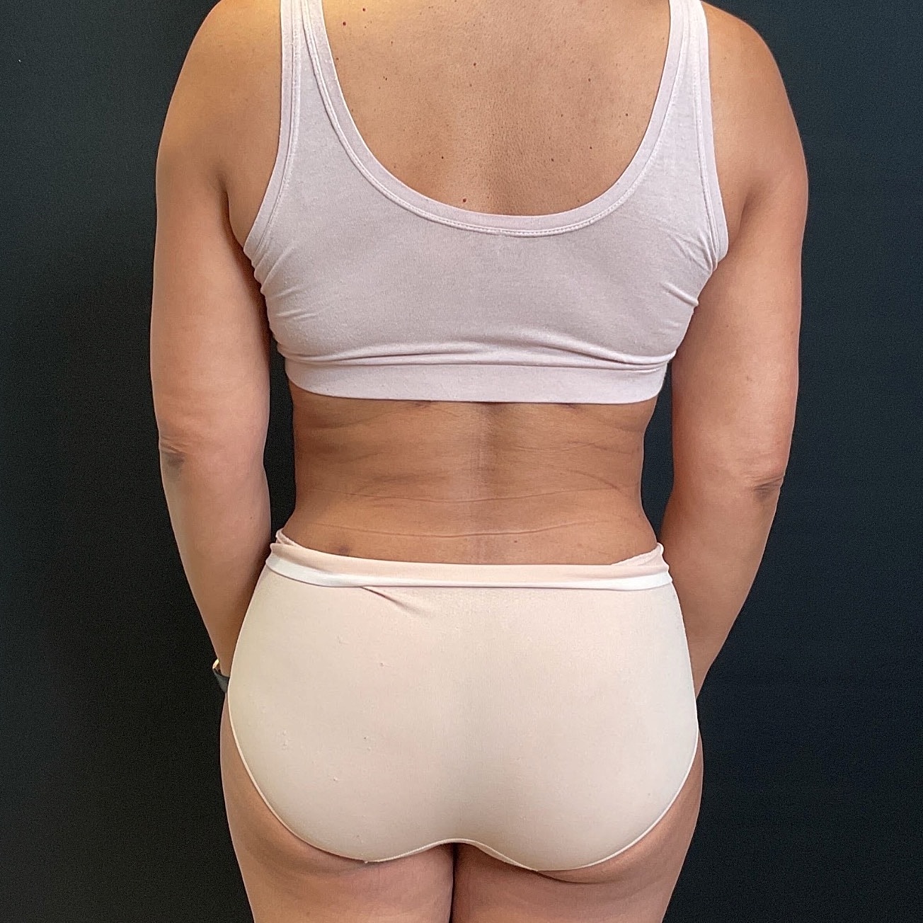 Liposuction Before & After