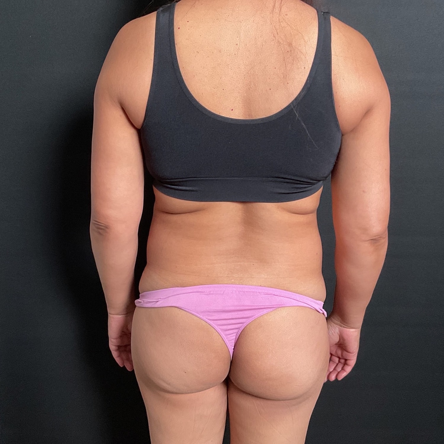 Liposuction Before & After