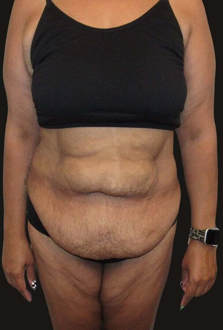 After Weight Loss Surgery Before & After