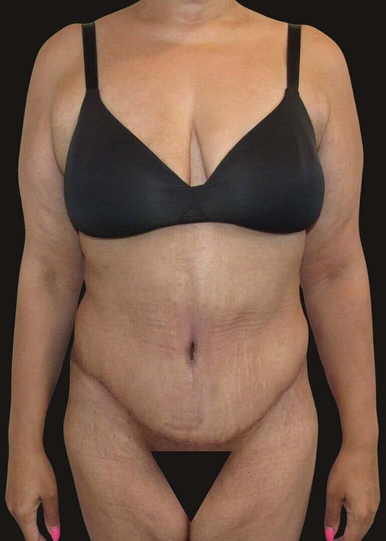 After Weight Loss Surgery Before & After