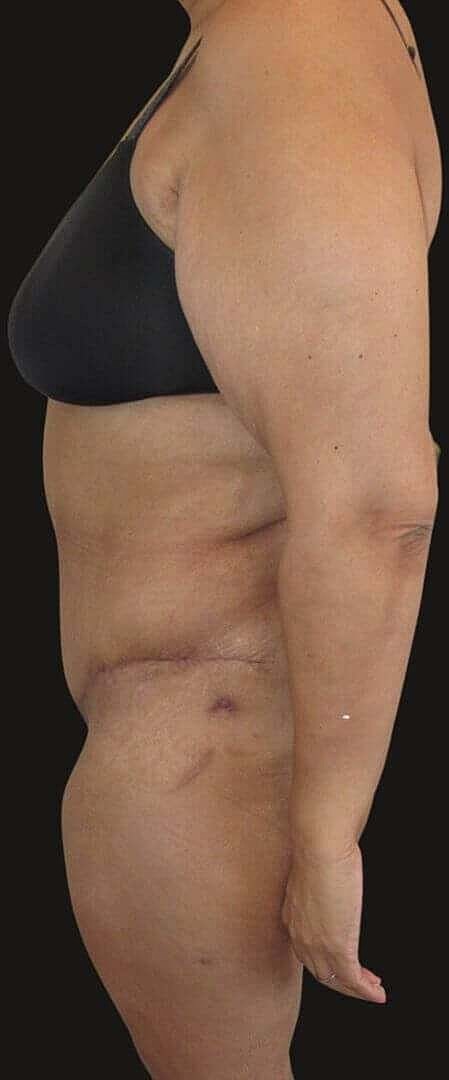 After Weight Loss Surgery Before & After