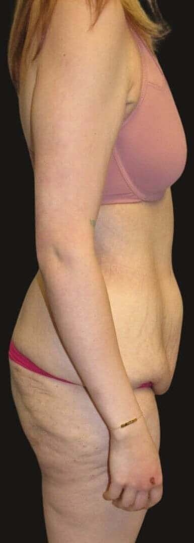 After Weight Loss Surgery Before & After