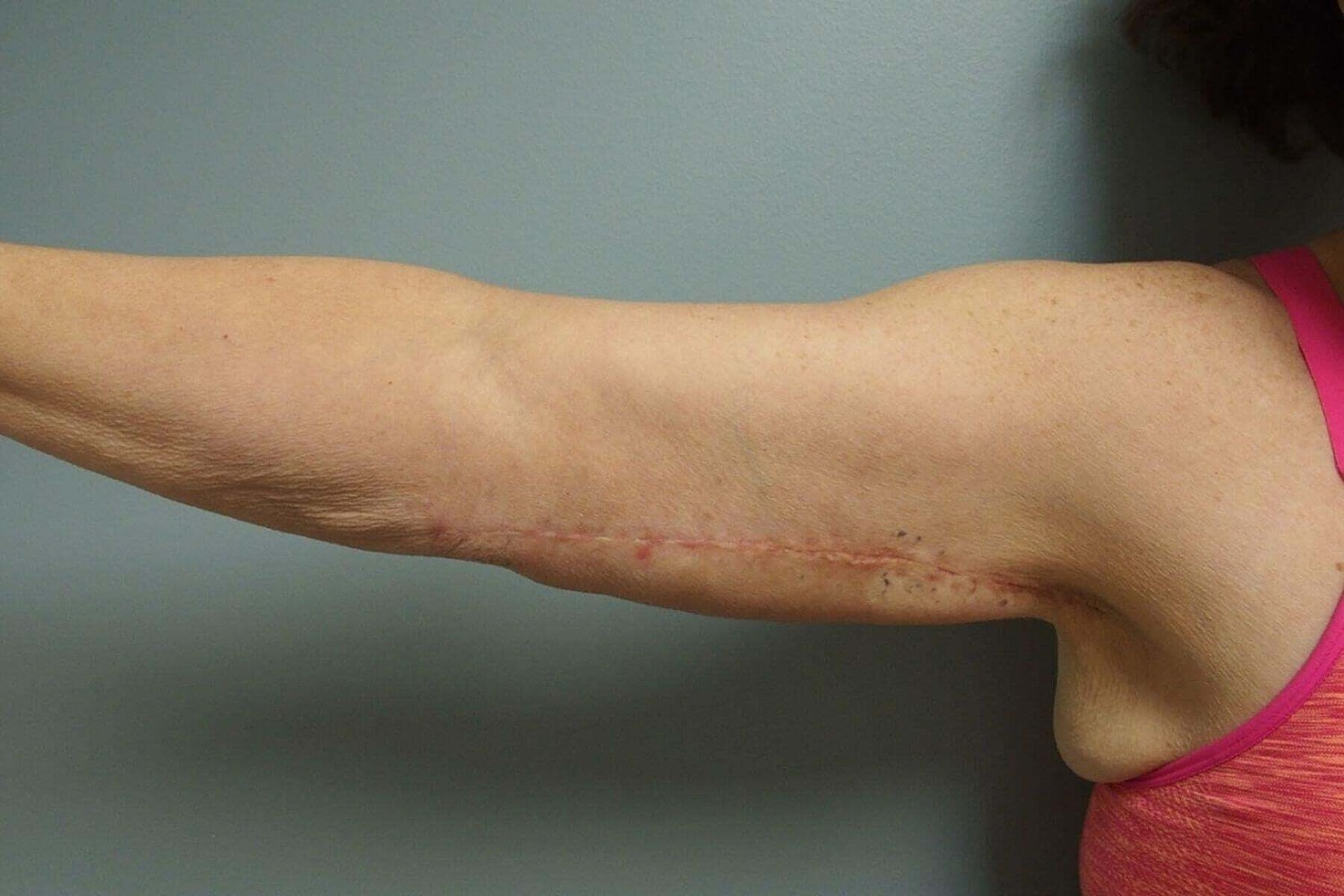 After Weight Loss Surgery Before & After