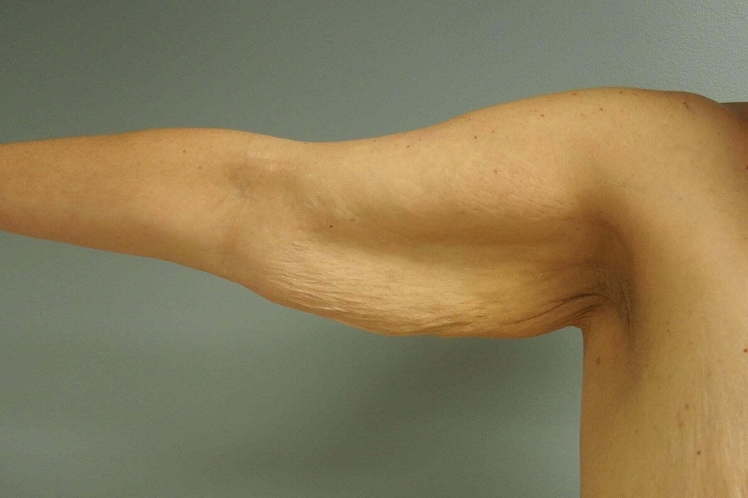 After Weight Loss Surgery Before & After