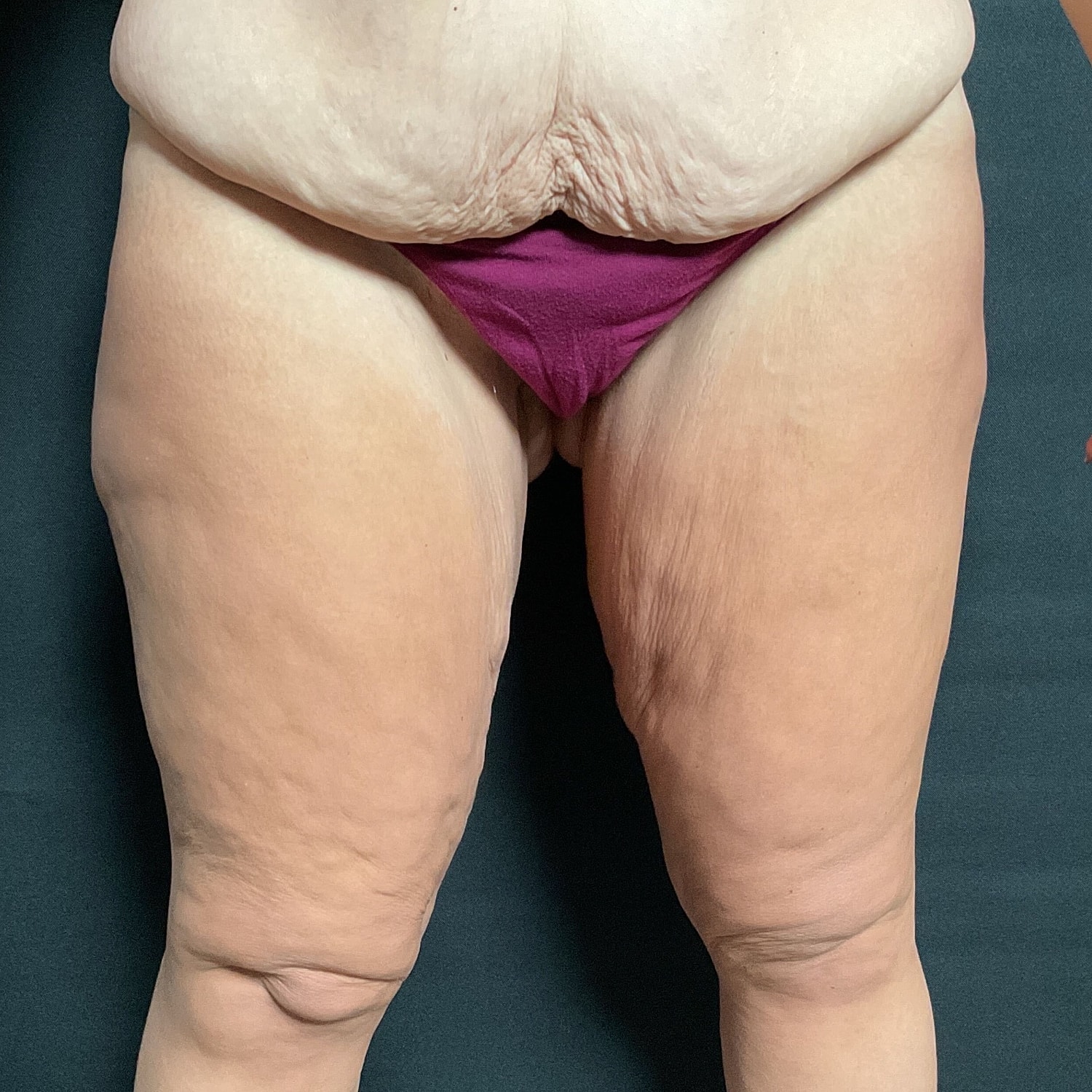 After Weight Loss Surgery Before & After