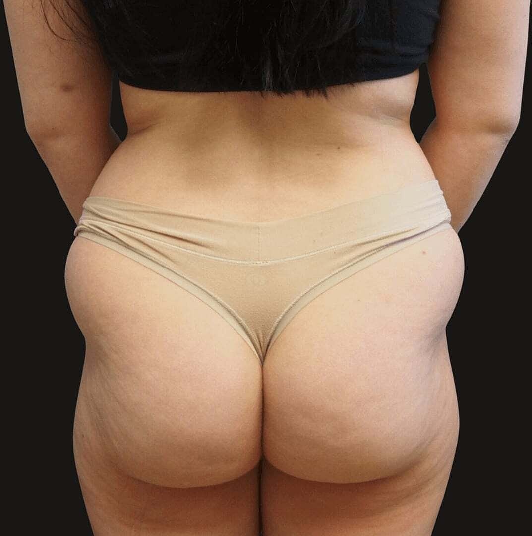 Brazilian Butt Lift Before & After