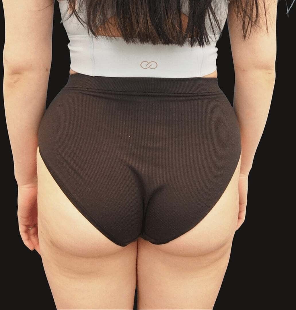 Brazilian Butt Lift Before & After