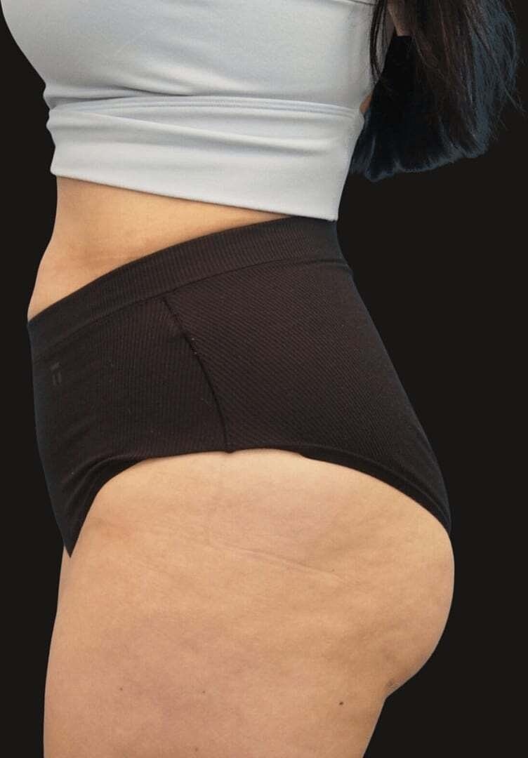 Brazilian Butt Lift Before & After