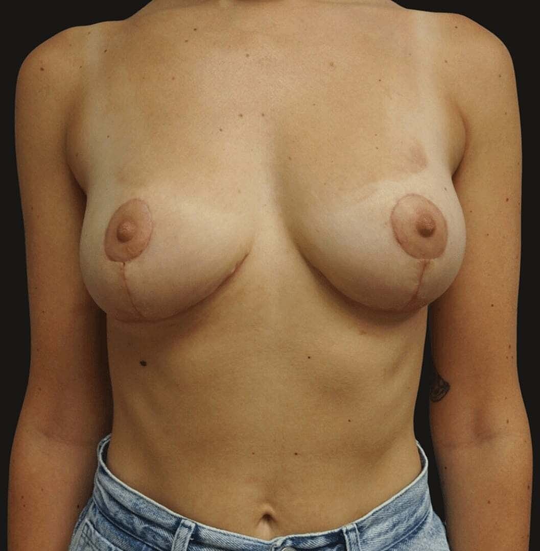 Breast Reduction And Lift Before & After